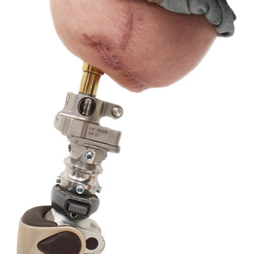 Osseointegration