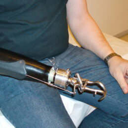 Kabelstyret underarmsprotese