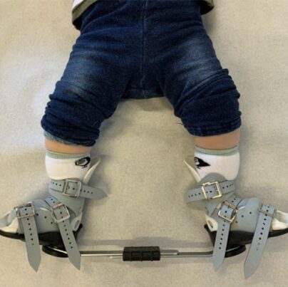 Til børn der er født med klumpfod