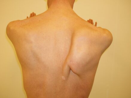 scapula-alata-englevinge-1 Scapula Alata Englevinge