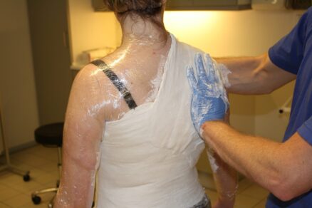 scapula-alata-englevinge-2 Scapula Alata Englevinge 2